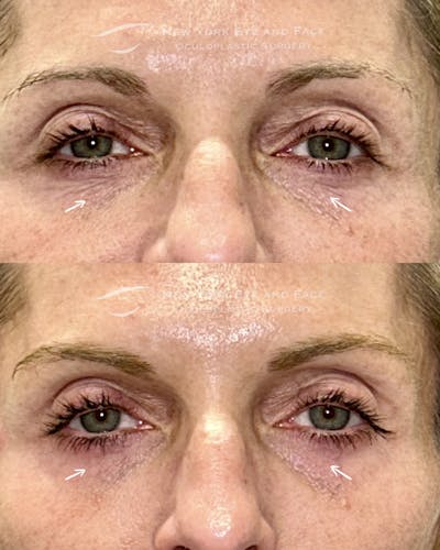 AcuPulse CO2 Laser Before & After Gallery - Patient 351416 - Image 1