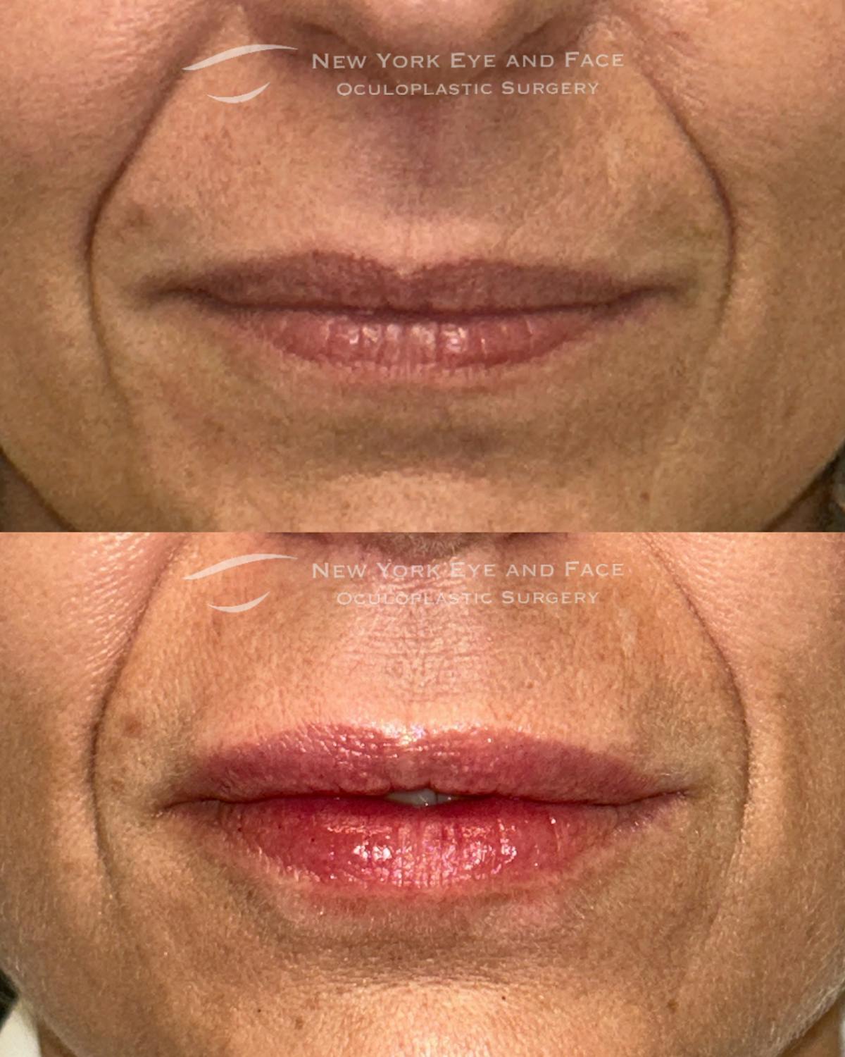 Lip Fillers Before & After Gallery - Patient 306389 - Image 1