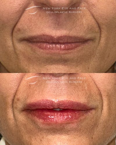 Lip Fillers Before & After Gallery - Patient 306389 - Image 1