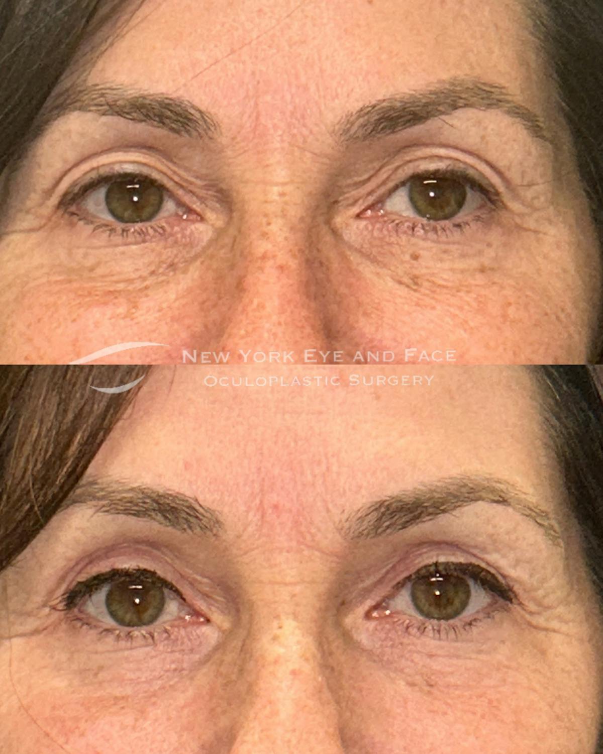 Upper Blepharoplasty Before & After Gallery - Patient 162804 - Image 1