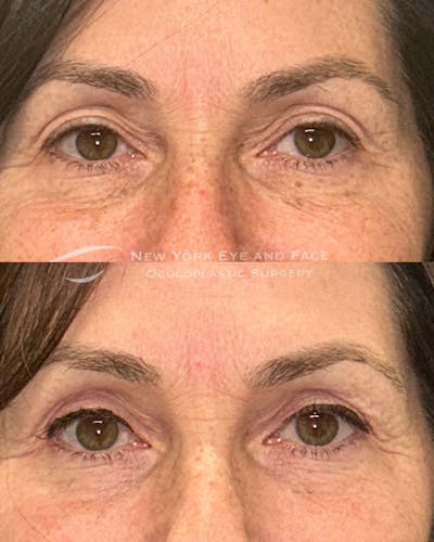 Upper Blepharoplasty Before & After Gallery - Patient 162804 - Image 1