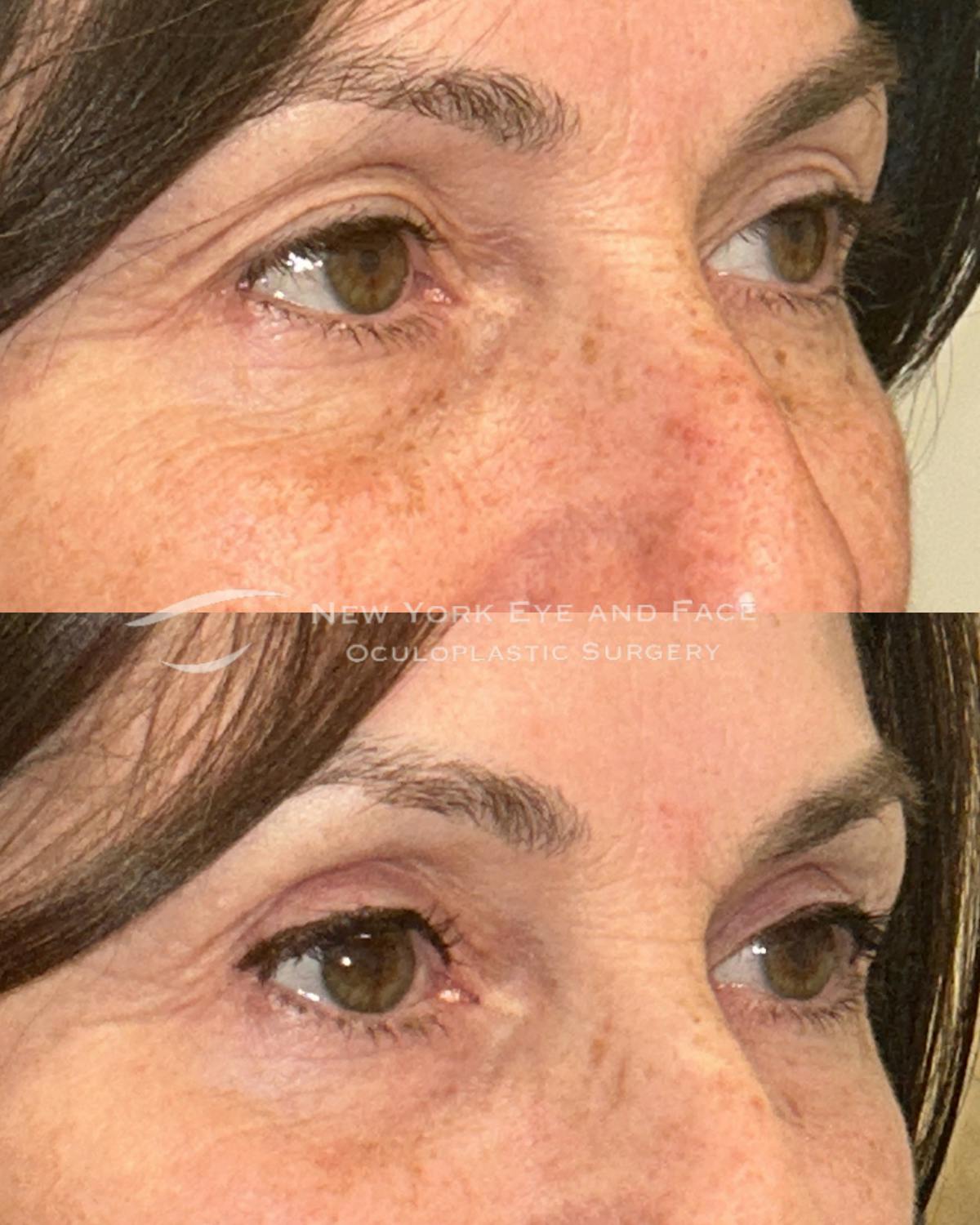 Upper Blepharoplasty Before & After Gallery - Patient 162804 - Image 2