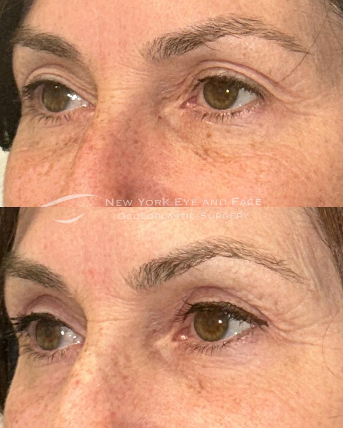 Upper Blepharoplasty Before & After Gallery - Patient 162804 - Image 3