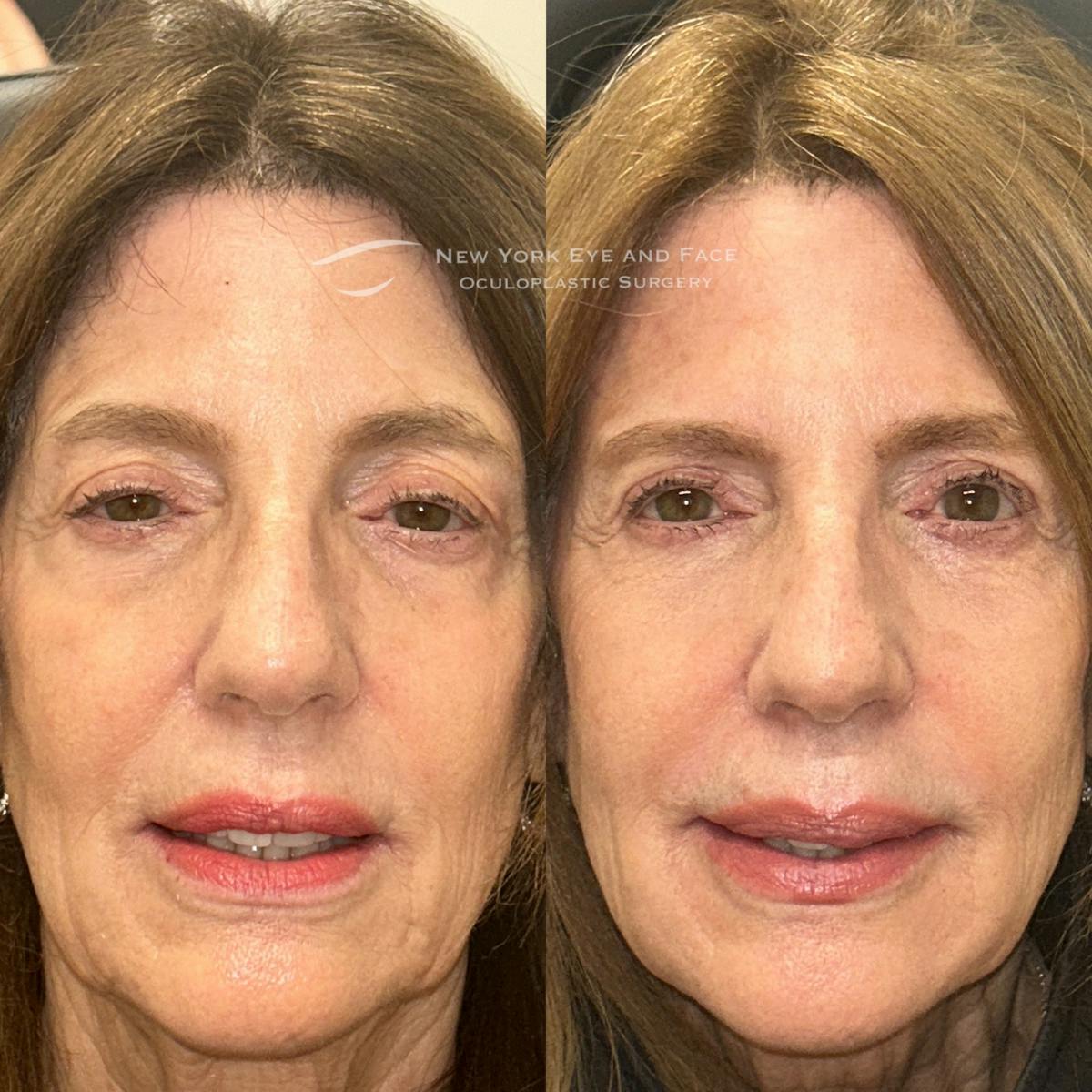 Ptosis  Before & After Gallery - Patient 131398 - Image 1