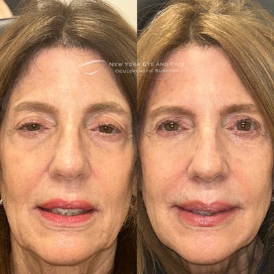 Dermal Fillers Before & After Gallery - Patient 404388 - Image 1
