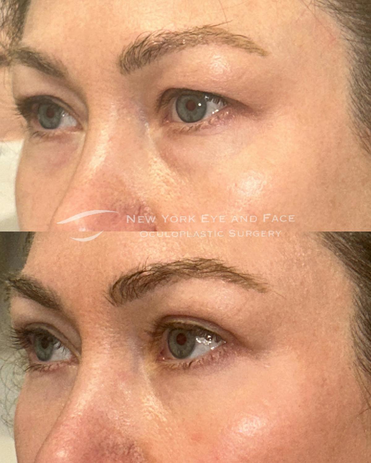 Brow Lift Before & After Gallery - Patient 382923 - Image 2