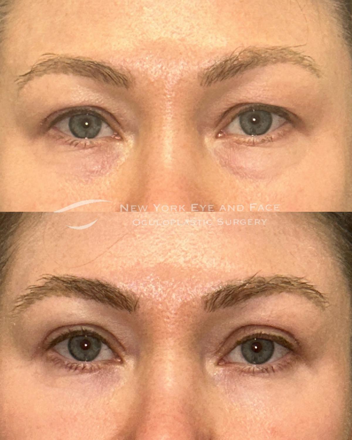 Brow Lift Before & After Gallery - Patient 382923 - Image 1
