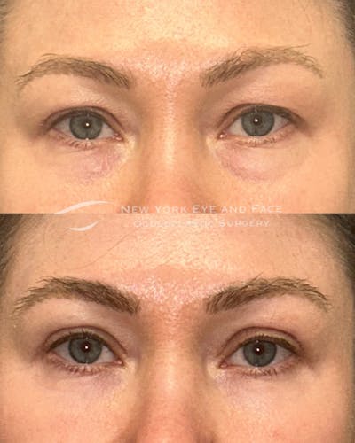 Upper Blepharoplasty Before & After Gallery - Patient 420594 - Image 1