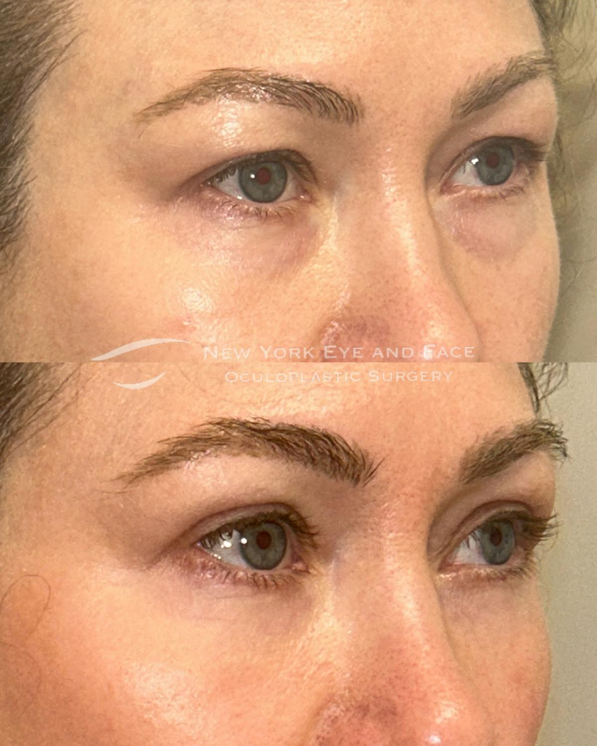 Brow Lift Before & After Gallery - Patient 382923 - Image 3