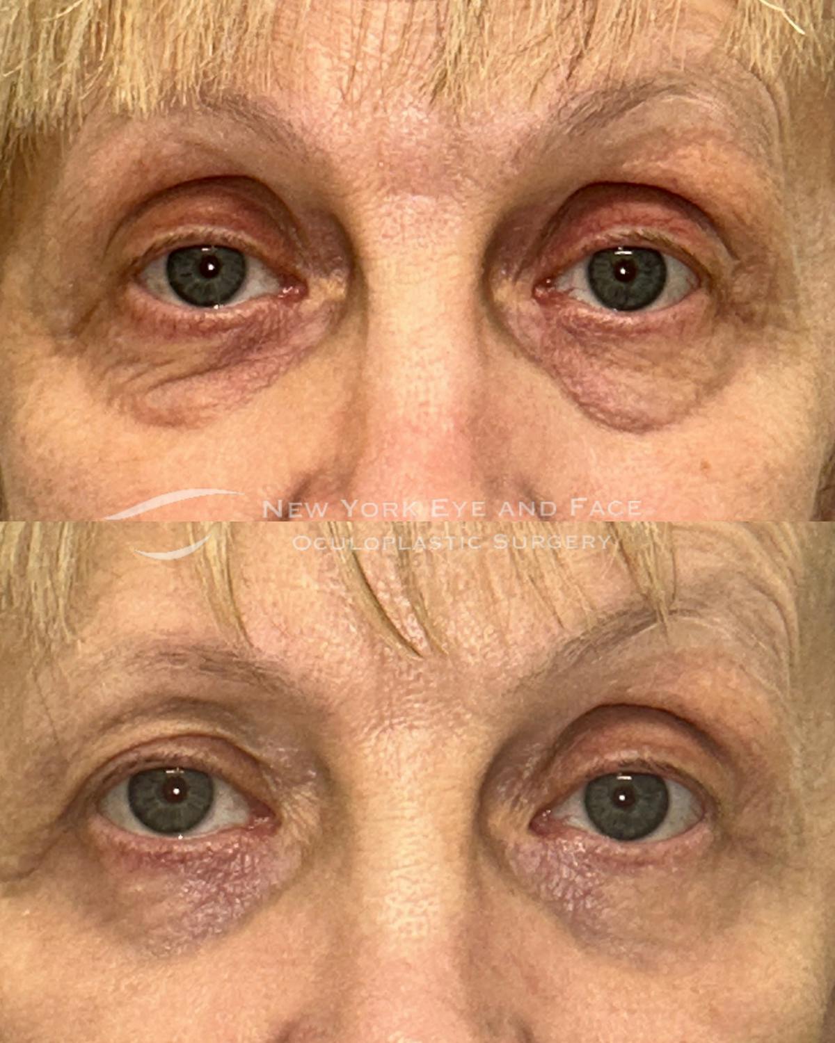 AcuPulse CO2 Laser Before & After Gallery - Patient 166038 - Image 1