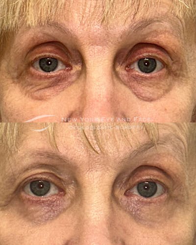 Lower Blepharoplasty Before & After Gallery - Patient 343276 - Image 1