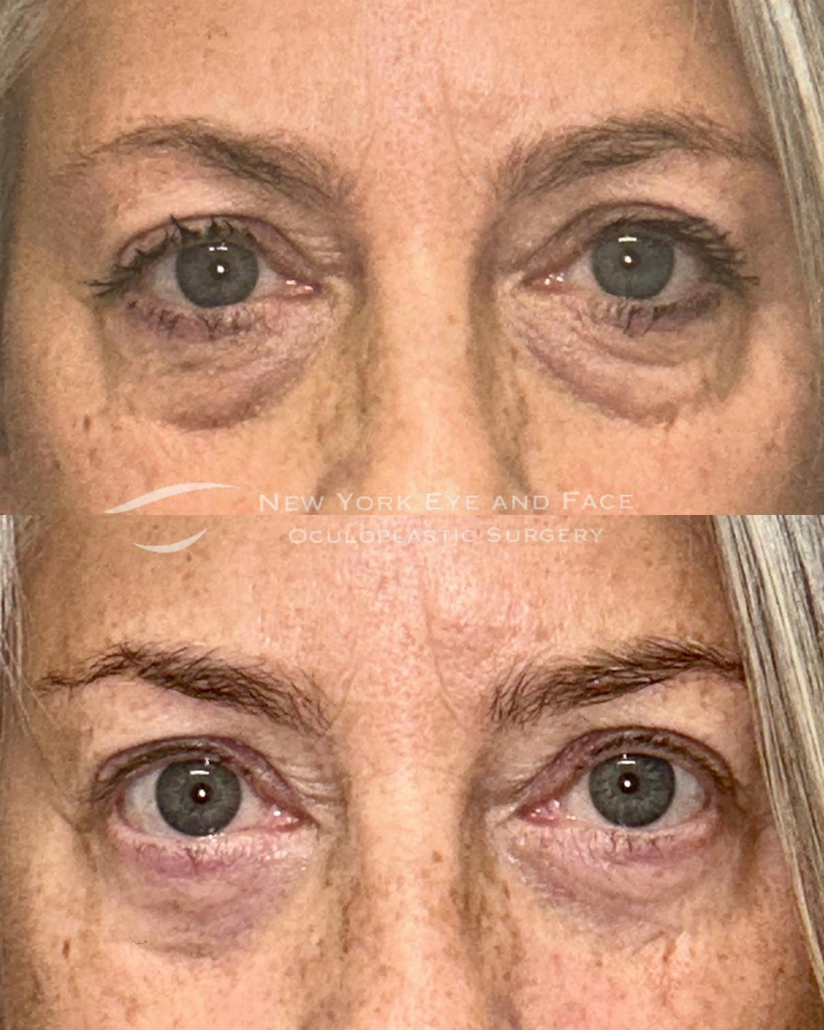 AcuPulse CO2 Laser Before & After Gallery - Patient 770903 - Image 1