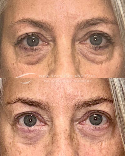 Lower Blepharoplasty Before & After Gallery - Patient 315511 - Image 1