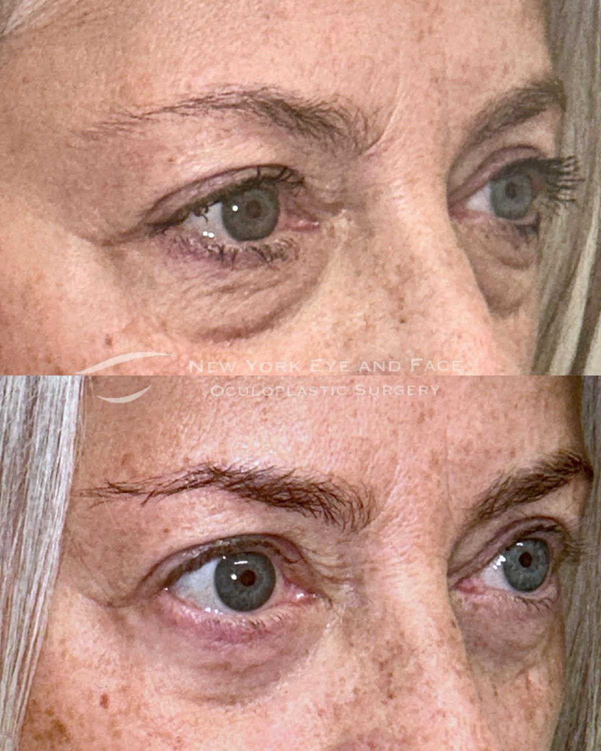 AcuPulse CO2 Laser Before & After Gallery - Patient 770903 - Image 2