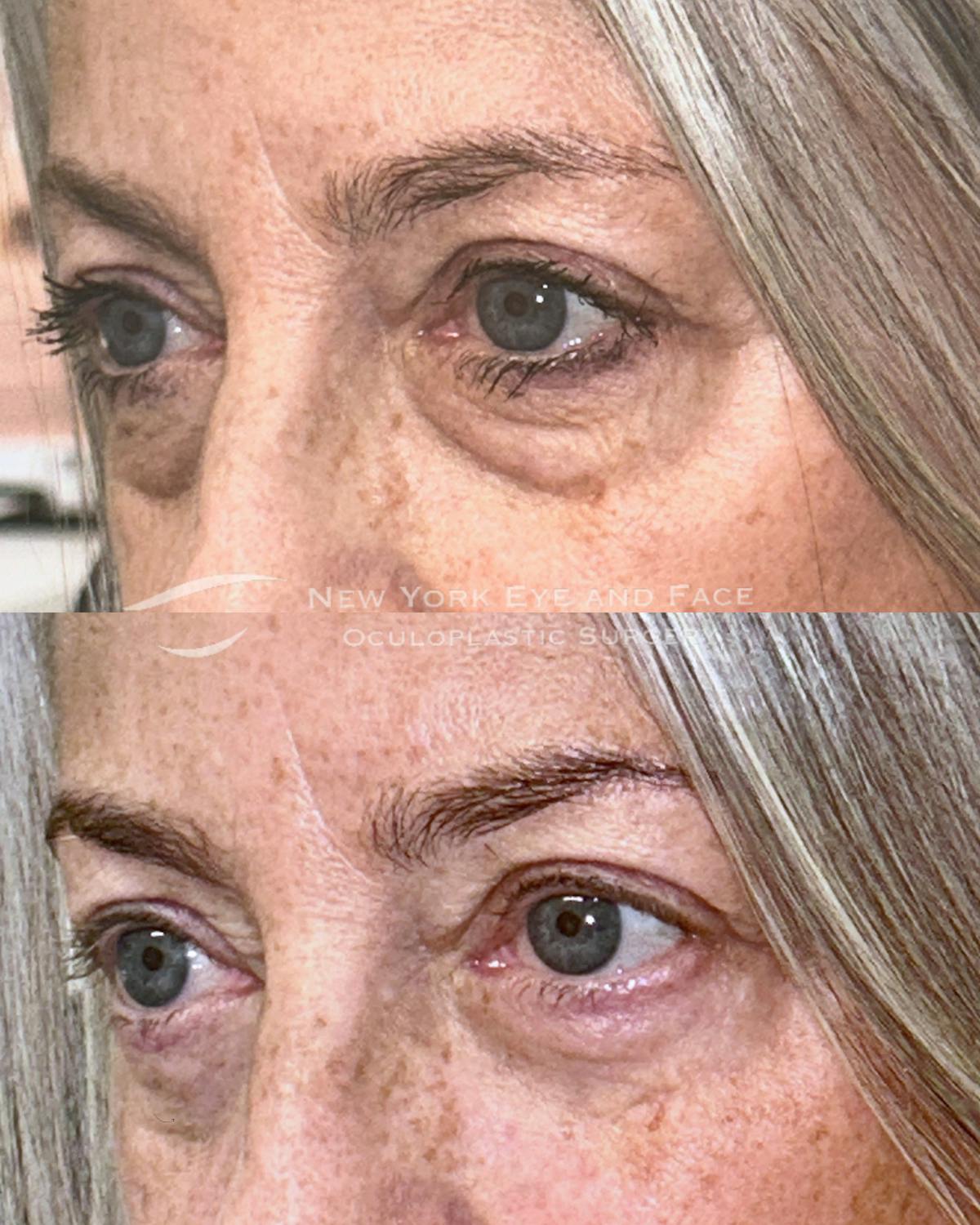 AcuPulse CO2 Laser Before & After Gallery - Patient 770903 - Image 3