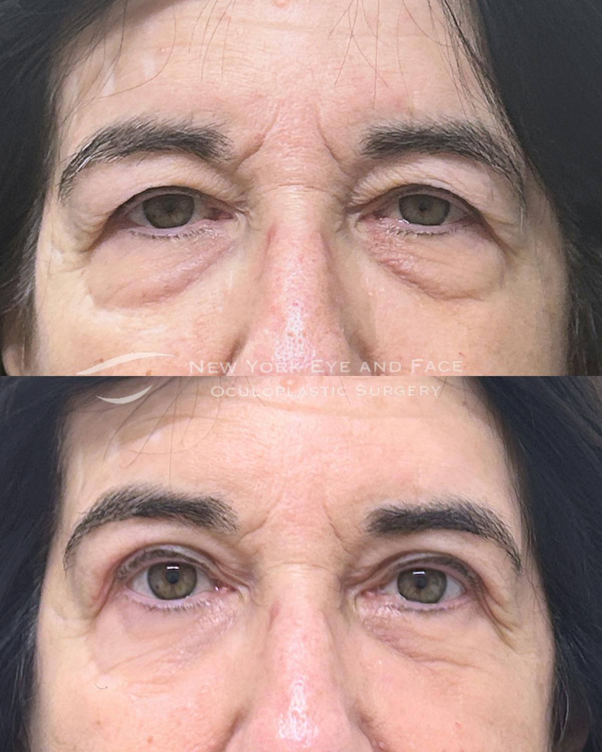 Upper Blepharoplasty Before & After Gallery - Patient 303681 - Image 1
