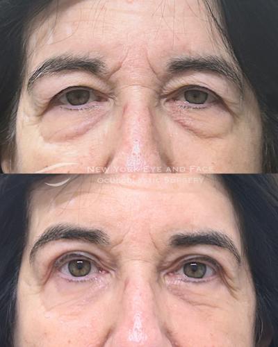 Upper Blepharoplasty Before & After Gallery - Patient 303681 - Image 1