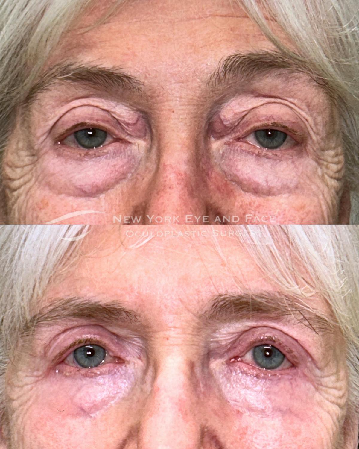 Lower Blepharoplasty Before & After Gallery - Patient 378458 - Image 1