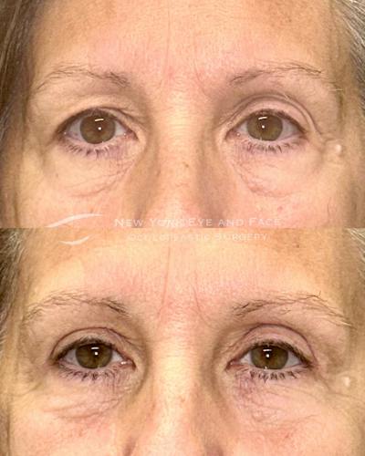 Upper Blepharoplasty Before & After Gallery - Patient 238161 - Image 1