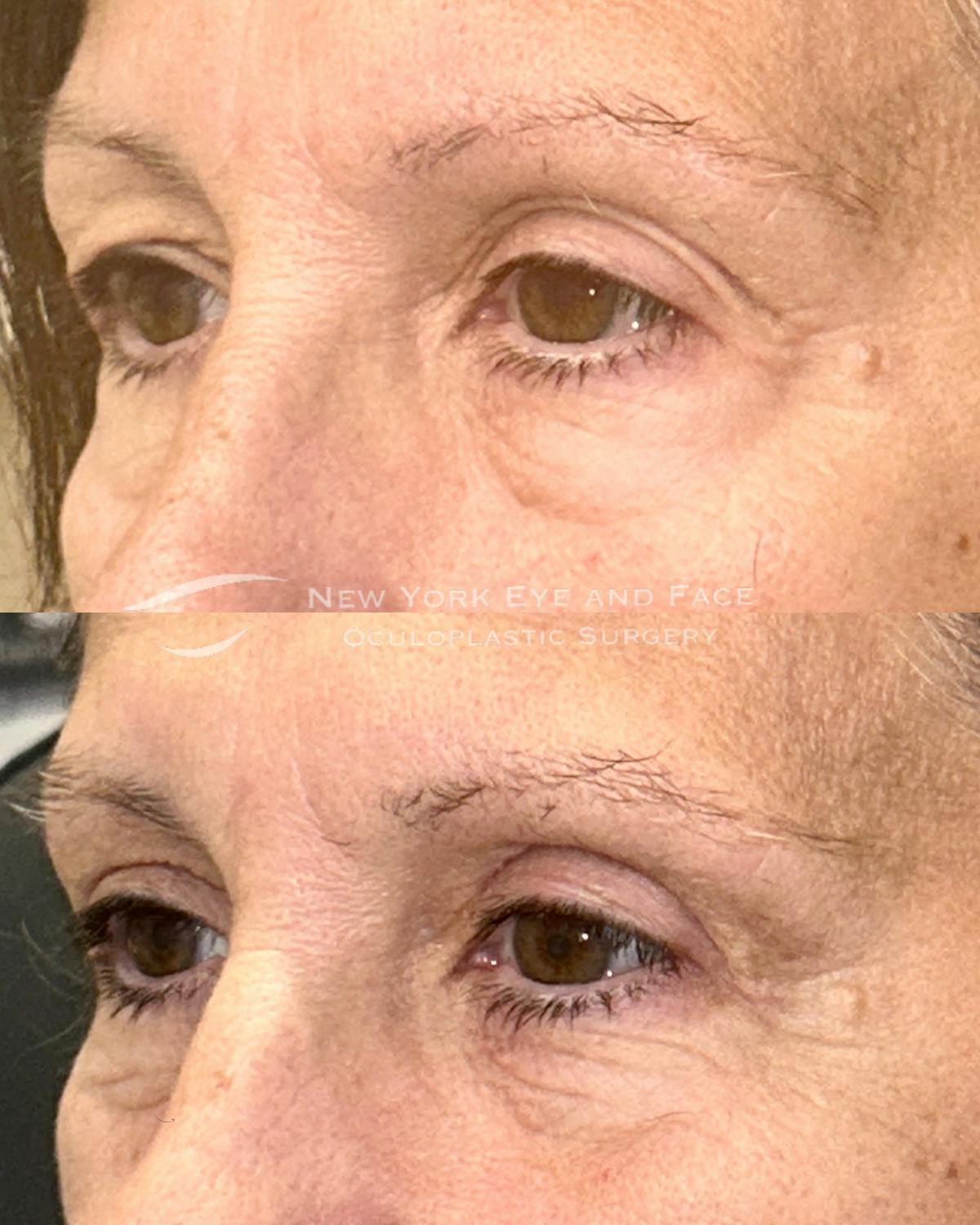 Brow Lift Before & After Gallery - Patient 336907 - Image 2