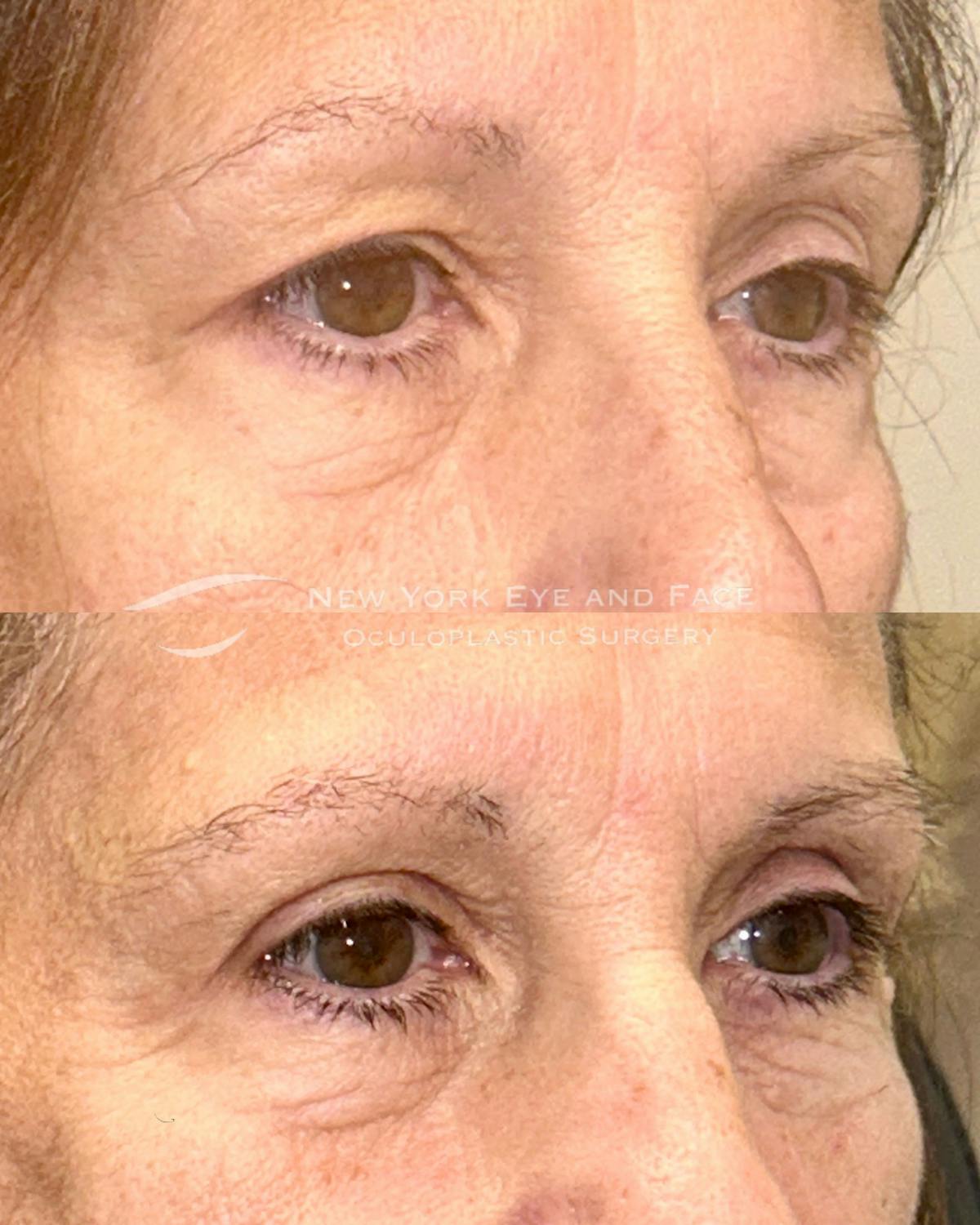 Brow Lift Before & After Gallery - Patient 336907 - Image 3