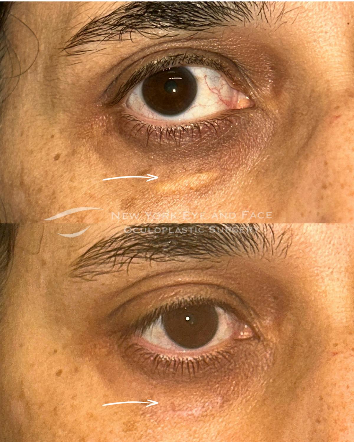 Xanthelasma Before & After Gallery - Patient 428026 - Image 1