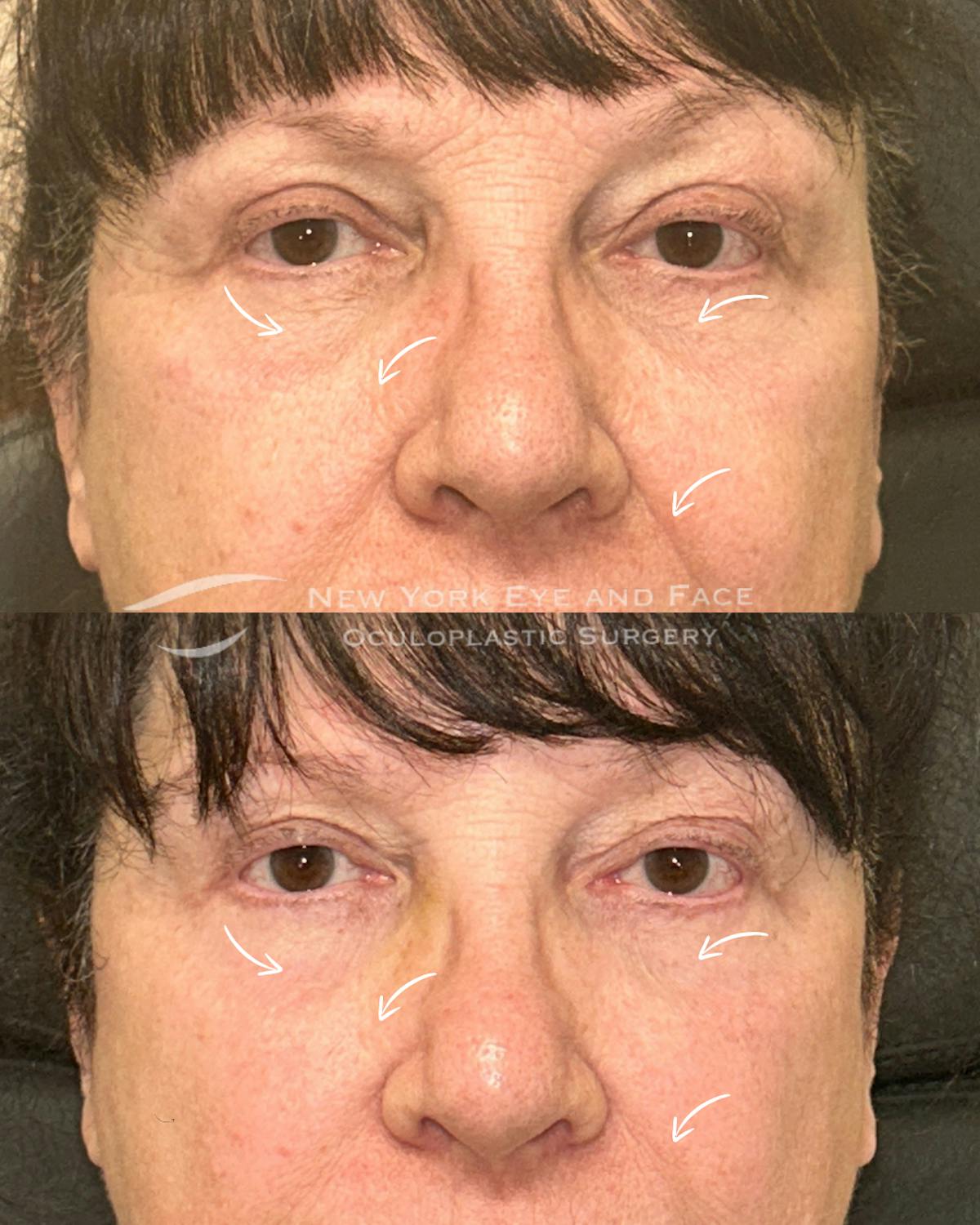 AcuPulse CO2 Laser Before & After Gallery - Patient 275434 - Image 1