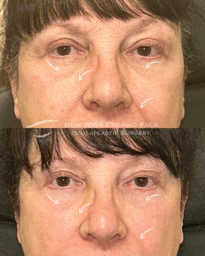 AcuPulse CO2 Laser Before & After Gallery - Patient 275434 - Image 1