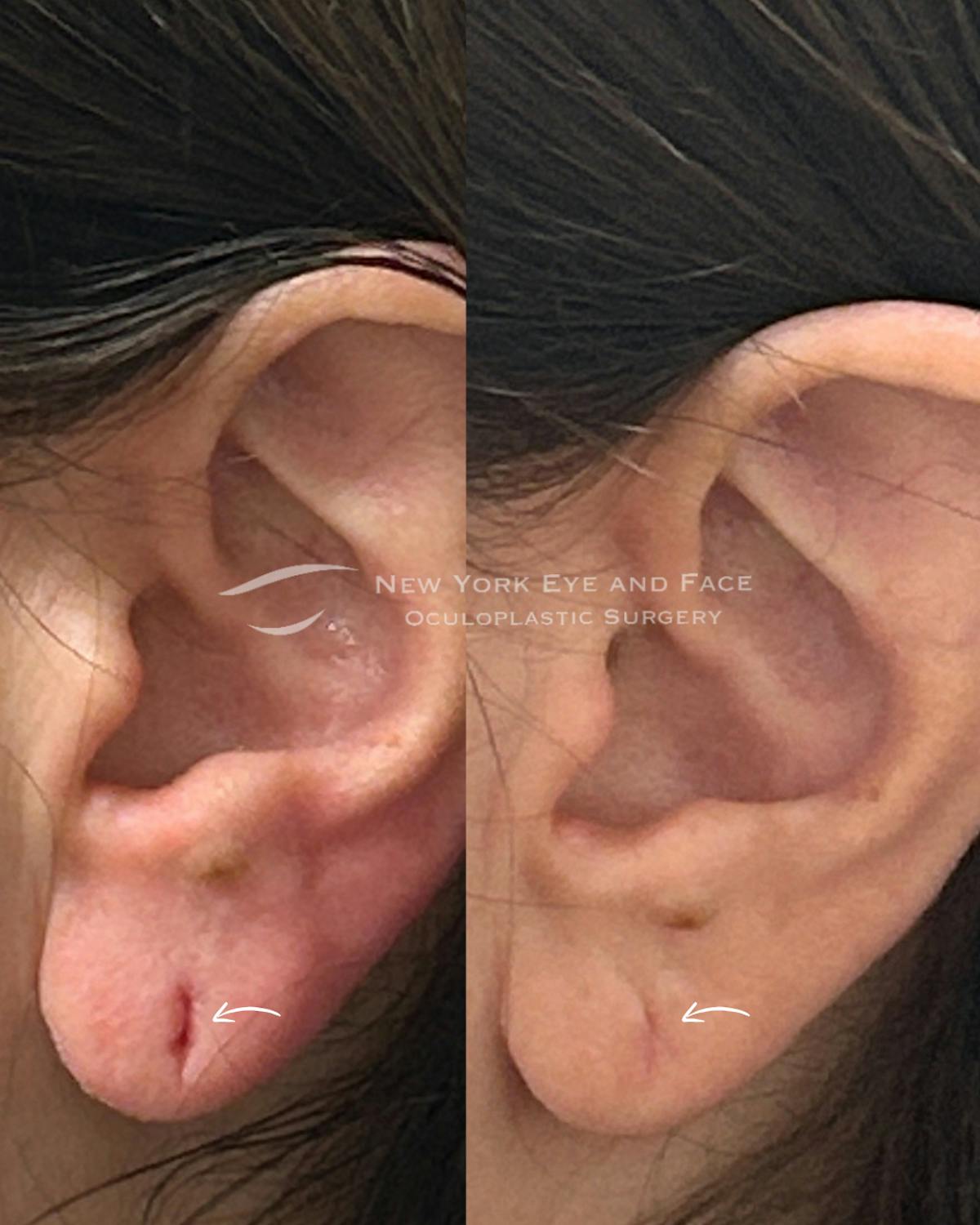 Earlobe Repair Before & After Gallery - Patient 968284 - Image 1