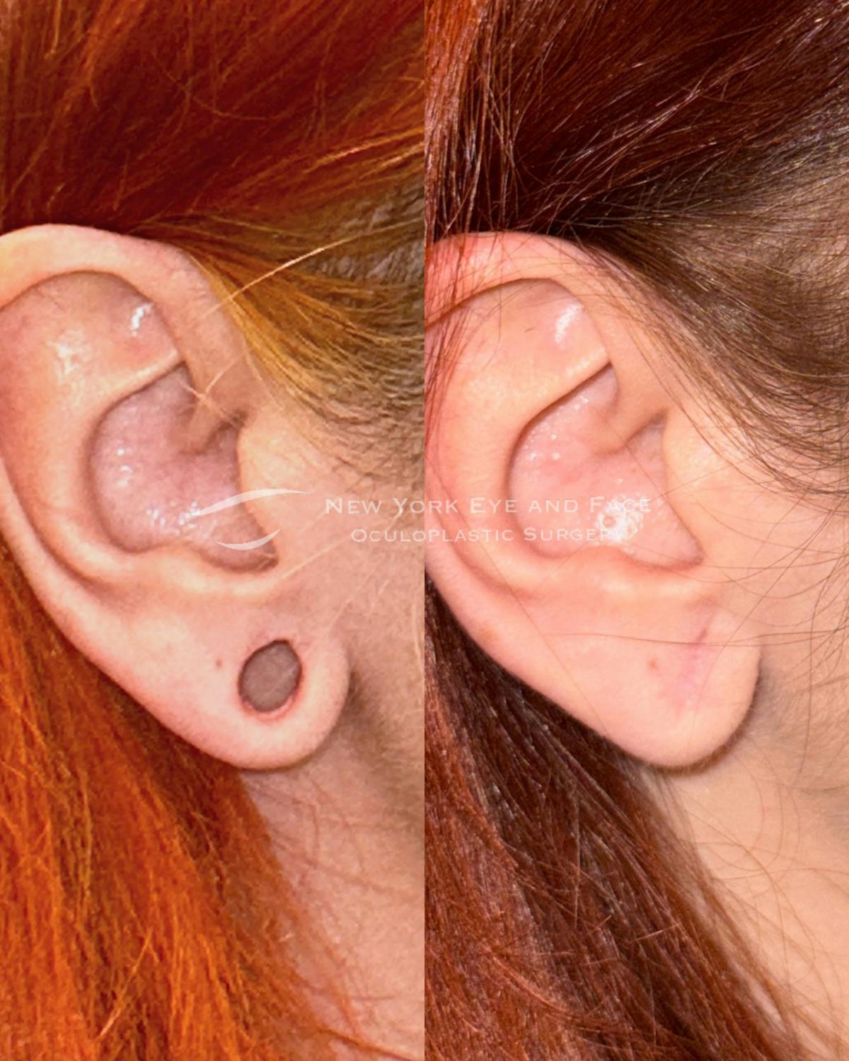Earlobe Repair Before & After Gallery - Patient 229784 - Image 2