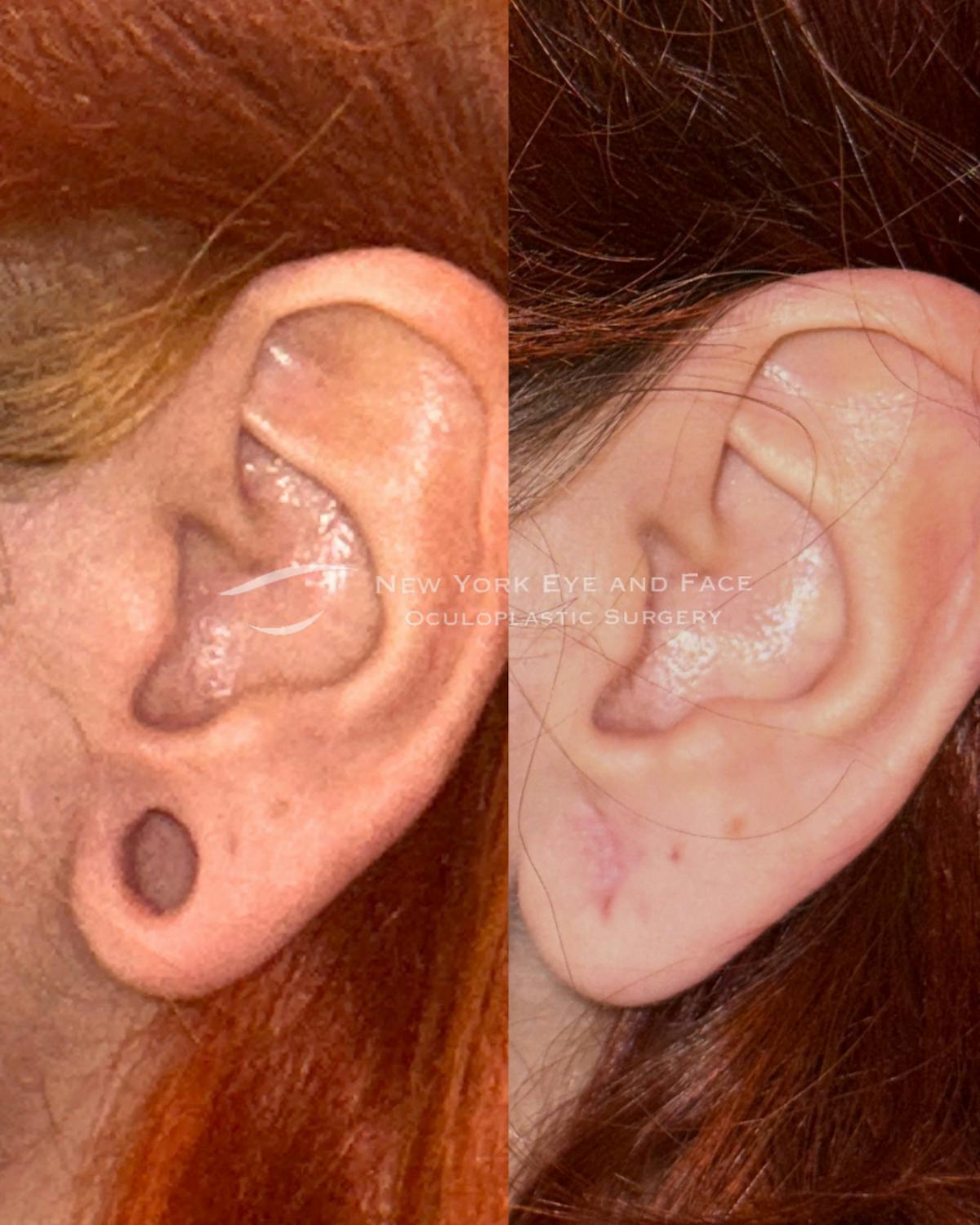 Earlobe Repair Before & After Gallery - Patient 229784 - Image 1