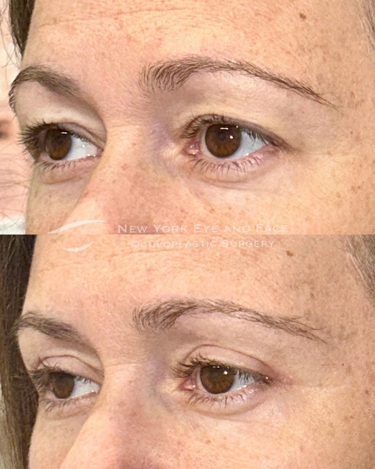 Upper Blepharoplasty Before & After Gallery - Patient 252710 - Image 3