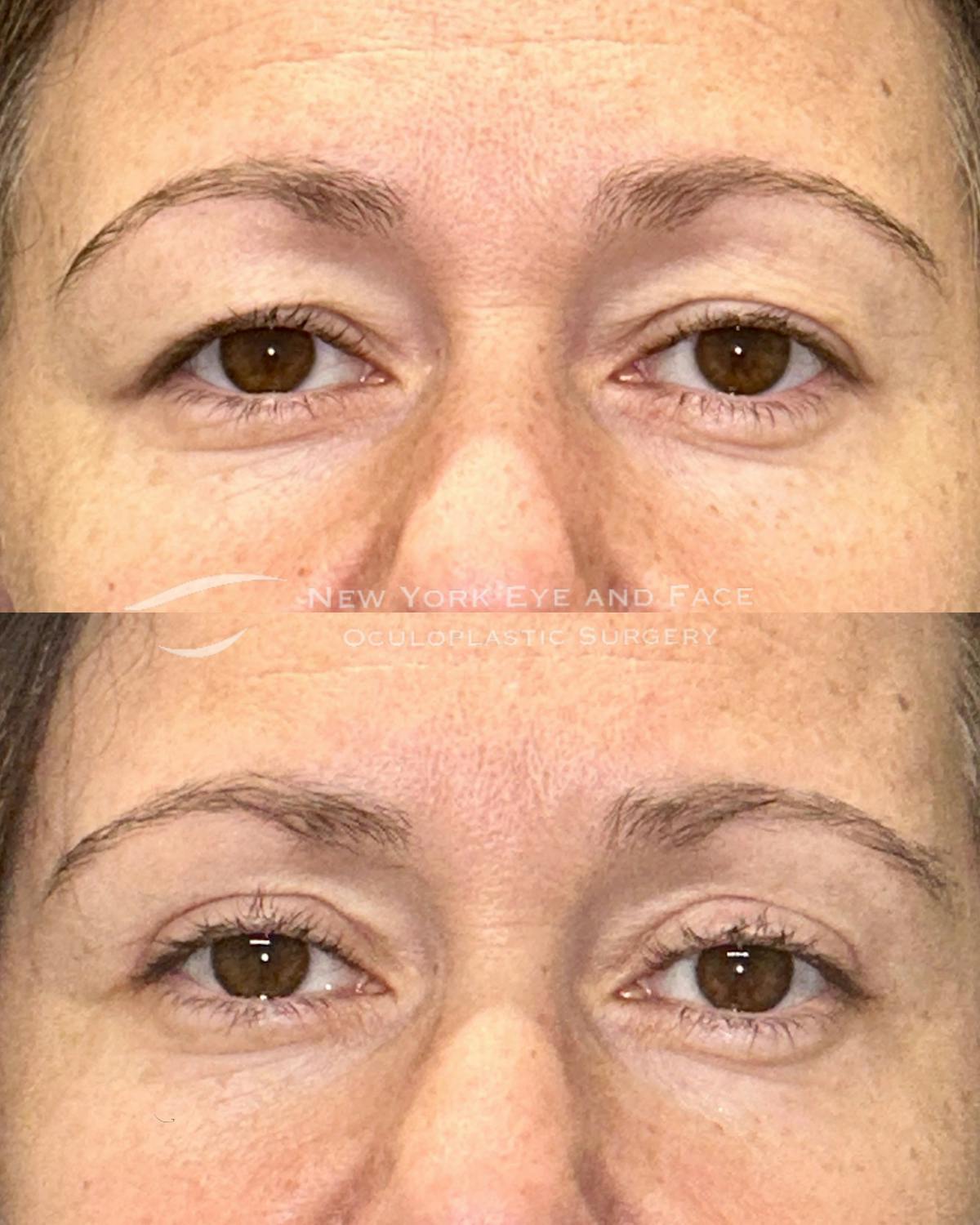Upper Blepharoplasty Before & After Gallery - Patient 252710 - Image 1