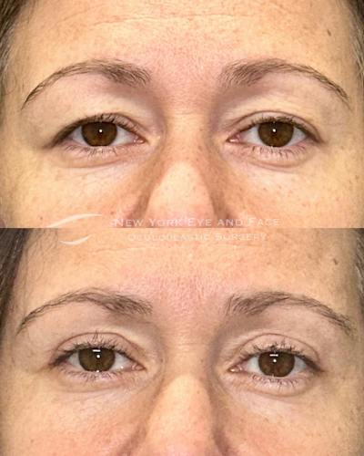 Upper Blepharoplasty Before & After Gallery - Patient 252710 - Image 1