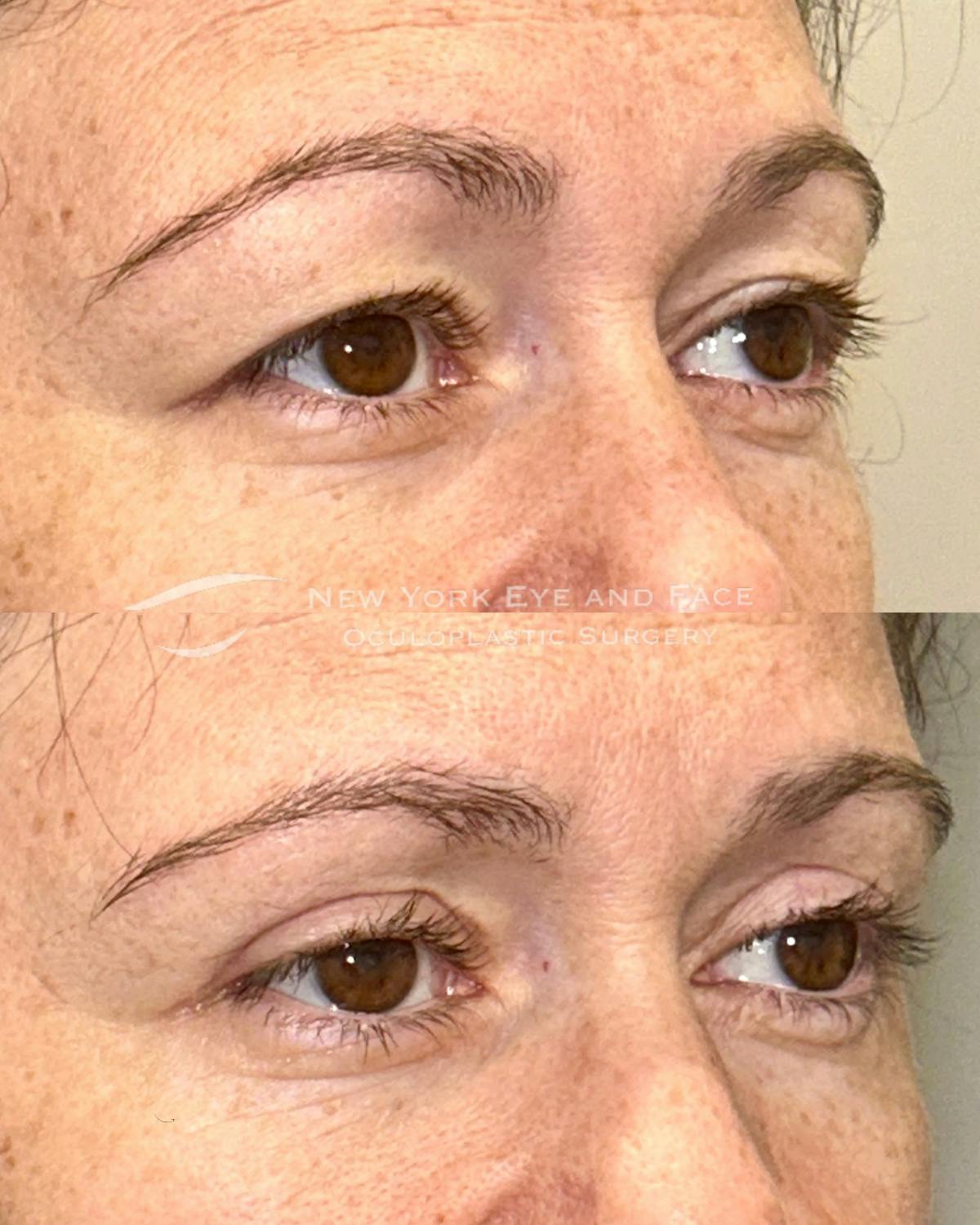 Upper Blepharoplasty Before & After Gallery - Patient 252710 - Image 2