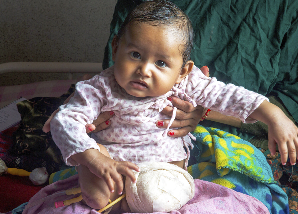 Injured baby at Kanti Children's Hospital