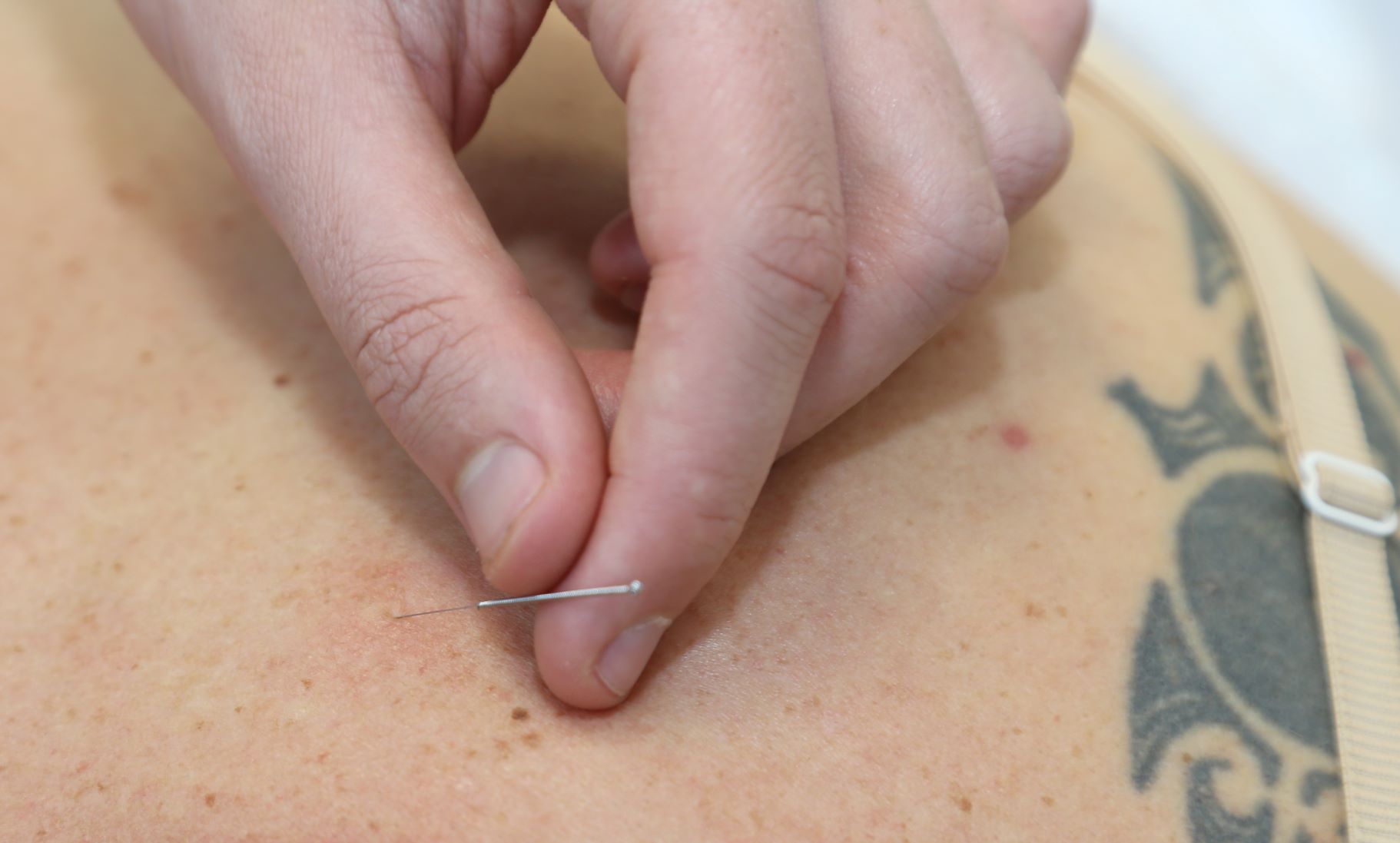 acupuncture 4
