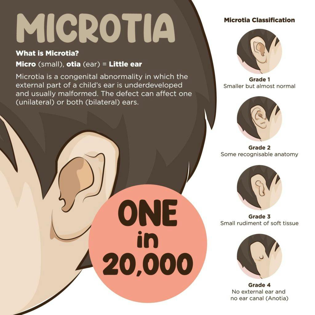 Microtia grade 1 hearing loss is typically minor, while severe to complete deafness can be experienced at higher grades