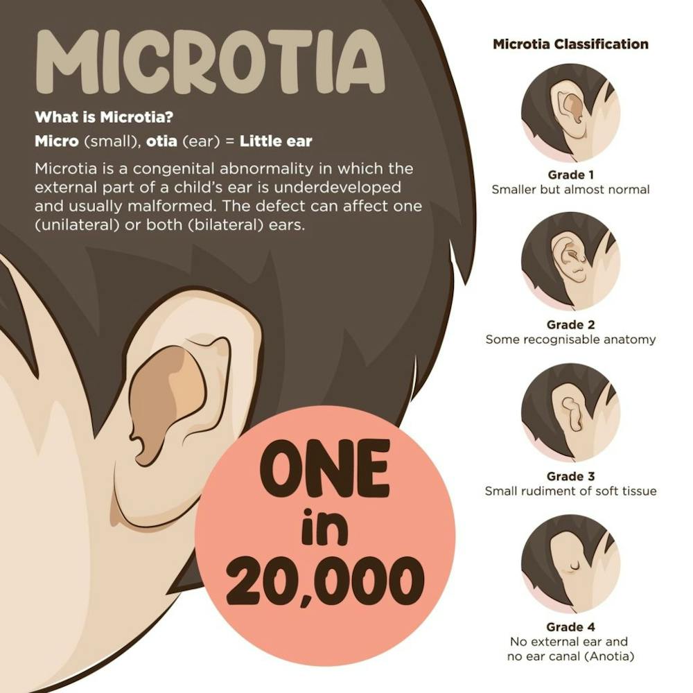 Microtia grade 1 hearing loss is typically minor, while severe to complete deafness can be experienced at higher grades