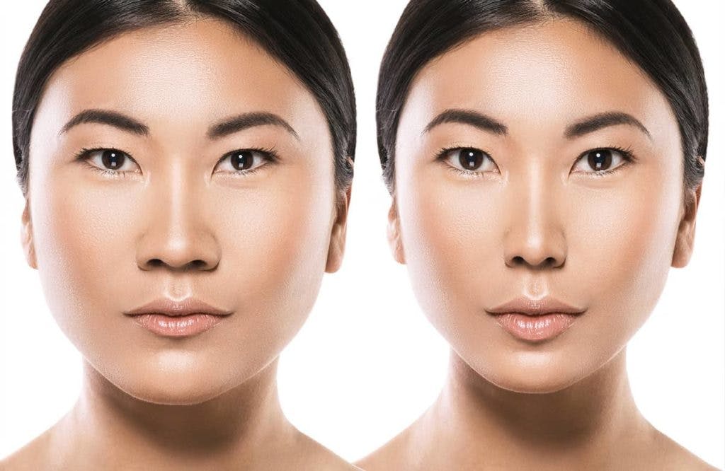 Asian ethnic nose job helps Asian patients achieve a nose shape that better reflects their unique heritage and characteristics