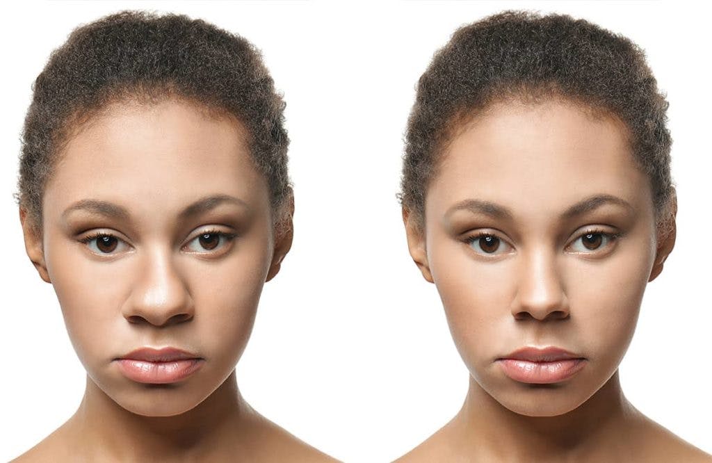 African American Rhinoplasty aims to reduce the bridge of the nose, narrow the nostrils, and refine the shape of the nose tip