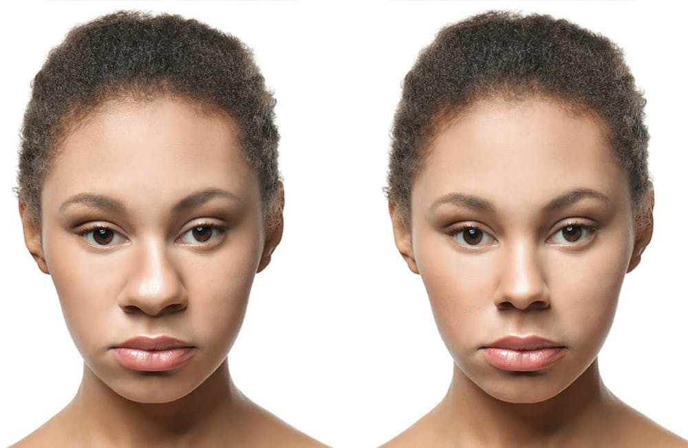 African American Rhinoplasty aims to reduce the bridge of the nose, narrow the nostrils, and refine the shape of the nose tip