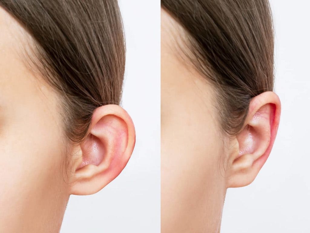 Physicians suggest that patients elevate their heads to maintain the ideal height of the ears and optimize blood flow during otoplasty recovery