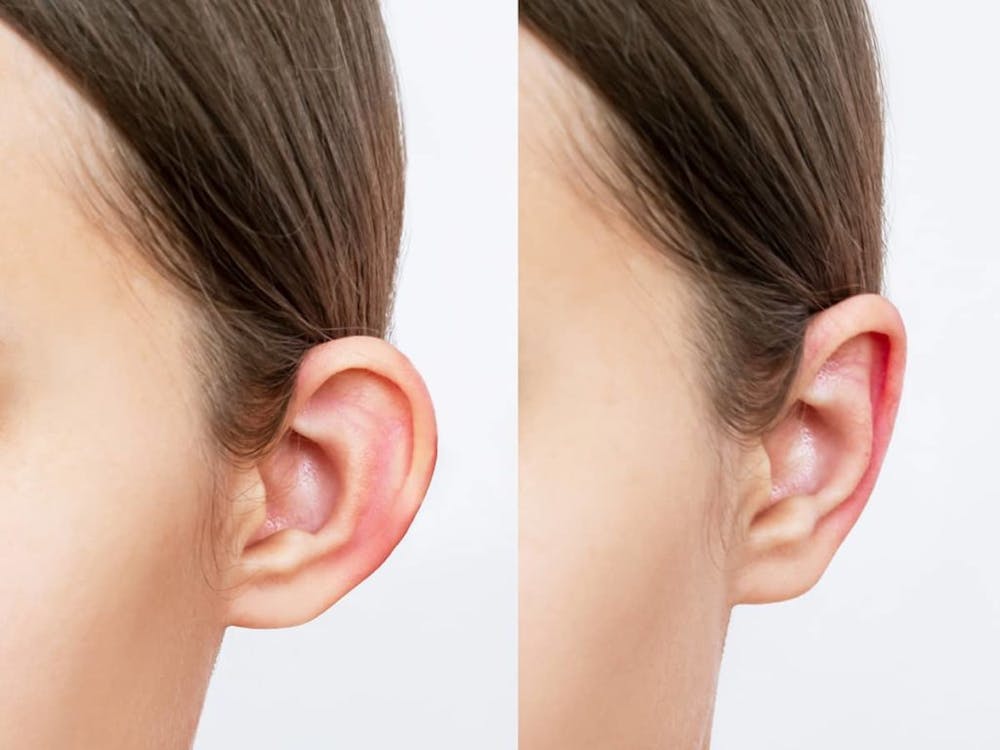 Physicians suggest that patients elevate their heads to maintain the ideal height of the ears and optimize blood flow during otoplasty recovery