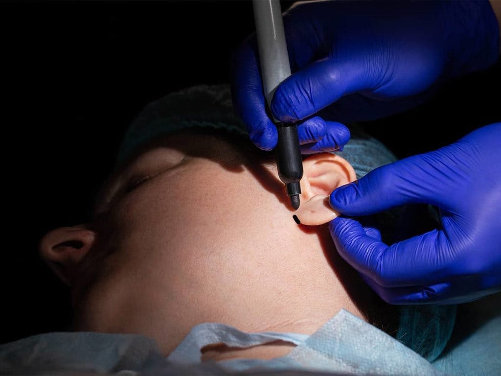 How long otoplasty takes can vary depending on the structure of your ears, any medical tests that may be required, and other factors.