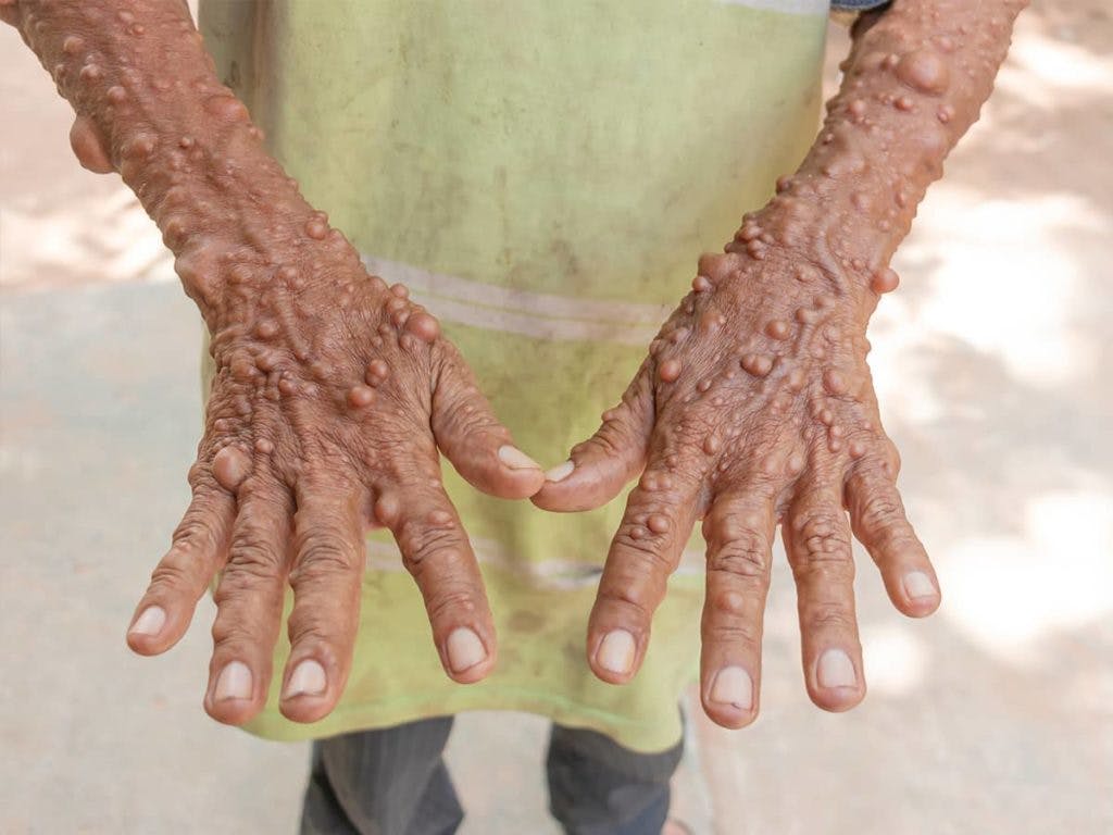 Genetic testing can reveal if someone has a familial connection to Neurofibromatosis Type 3, which may assist in an accurate diagnosis