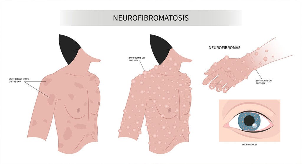 Injury to the facial nerve is a risk of neurofibroma-removal surgery, as it is vulnerable during the operation