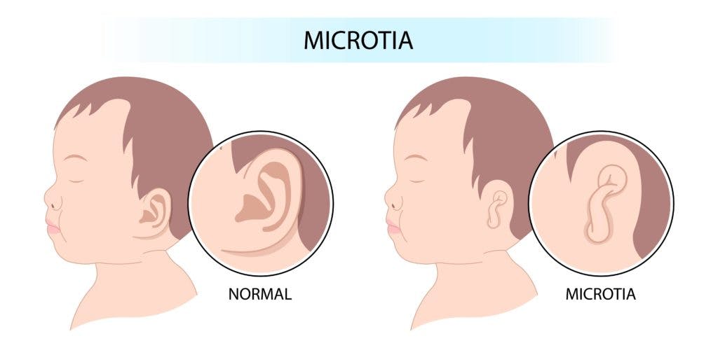 Microtia and atresia are two rare congenital conditions that affect the formation of the ear and ear canal