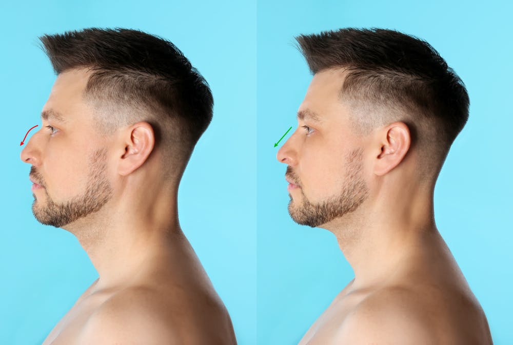Closed rhinoplasty, especially the scarless approach, offers quicker healing and minimal swelling.