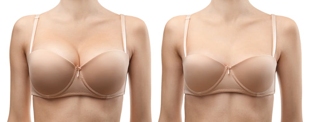 The lollipop technique enables precise adjustments to lift and shape the breast.